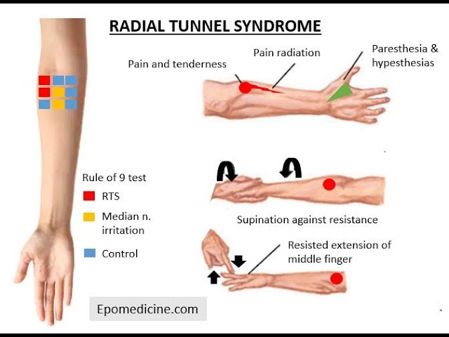 <p>-dull ache to the proximal lateral forearm (effects the posterior interosseous nerve [deep radial nerve that controls wrist and finger extension]</p><p>-OT recs</p><ul><li><p>long arm splint with wrist extension/elbow in flexion/wrist in neutral</p></li><li><p>TENs</p></li><li><p>Pt advised to avoid forceful wrist/finger extension and forearm supination</p></li></ul><p></p>