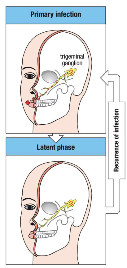 <ul><li><p>triggered by stress, UV exposure, fever, or immunosuppression </p></li><li><p>virus travels anterograde down the same axon to the peripheral site</p></li><li><p>local epithelial replication → recurrent cold sore or genital lesion </p></li><li><p>typically milder and shorter due to memory T- and B-cell response</p></li></ul><p></p>