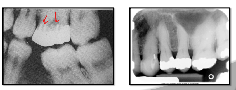 <p>Metallic pins are used to enhance retention of amalgam or composite </p><ul><li><p>appear as cylindrical or screw-shaped radiopacities. </p></li></ul><p></p>