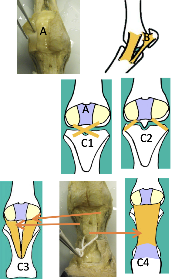 <p><strong>1) Inter-sesamoidean ligament </strong></p><ul><li><p>Is a fibrocartilage plate BETWEEN the proximal sesamoid bones </p></li><li><p>Allows for the smooth passage of the DDFT and the SDFT </p></li></ul><p></p><p><strong>2) Collateral sesamoidean ligaments </strong></p><ul><li><p>Attach the sesamoids to the MC3 and the proximal phalanx (see image B)</p></li></ul><p></p><p><strong>3) Distal sesamoidean ligaments - there are 4</strong></p><ul><li><p><u>Cruciate</u> and <u>short</u> - </p><ul><li><p>labeled C1 and C2, stabilize the sesamoids to the proximal phalanx</p></li></ul></li><li><p><u>Oblique</u> - </p><ul><li><p>Attach the sesamoids to the “v” shaped trough on the palmar aspect of the proximal phalanx, offers great stability </p></li></ul></li><li><p><u>Straight</u> - </p><ul><li><p>Overlays entire palmar aspect of the proximal phalanx</p></li><li><p>Inserts with the SDFT</p></li></ul></li></ul><p></p>
