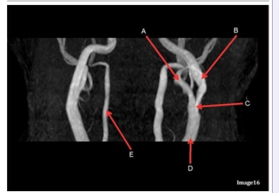 <p><span><strong>Letter E in Image 16 is responsible for blood supply to the:</strong></span></p><p><span>&nbsp;A. Anterior brain</span></p><p><span>&nbsp;B. Posterior brain</span></p><p><span>&nbsp;C. Face</span></p><p><span>&nbsp;D. Upper extremities</span></p>