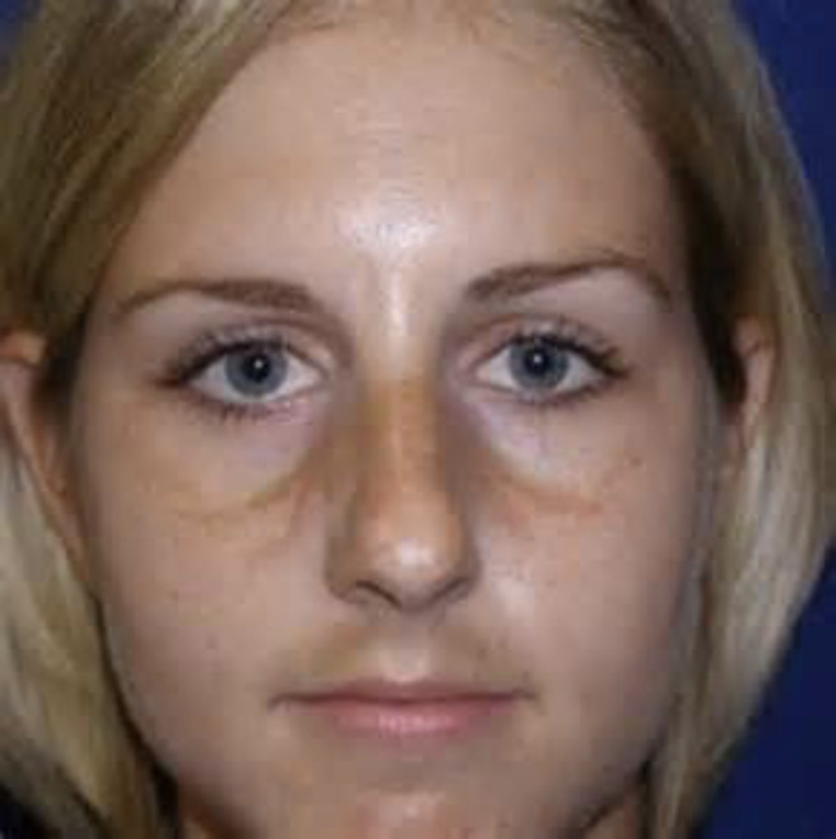 <p>brown pigmentation of forehead, cheeks &amp; nose</p>