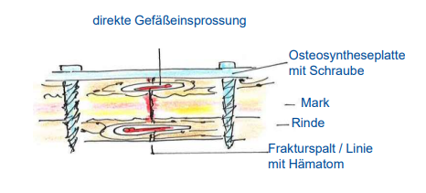 <p>Knochenbruchheilung</p><p><strong>Primäre Frakturheilung</strong></p>