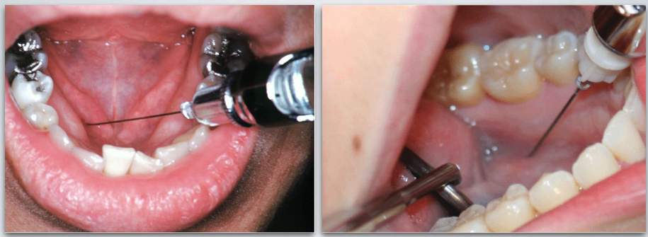 <ol><li><p>Use 25 gauge long needle</p></li><li><p>Retract the tongue</p></li><li><p>Direct the syringe from the opposite side</p></li><li><p>Direct needle tip to the apical region of the tooth immediately posterior to the tooth in question, until bone is contacted</p></li><li><p>Aspirate and deposit ~0.6 ml of solution</p></li></ol><p></p>