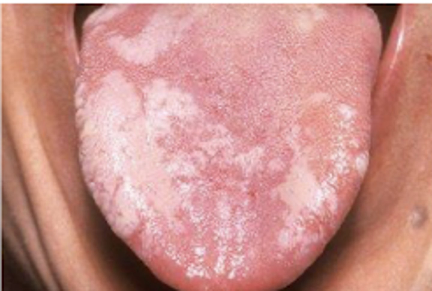 <p><strong>-patho:</strong> poorly understood</p><p>-Intermediate stage in oral carcinogenesis. </p><p>-Hyperkeratosis of the epithelium (thickening of the outer layer of cells)</p><p>-Inflammatory infiltrates (immune cells) in the tissue.</p><p>-Various levels of epithelial dysplasia</p><p>-Multiple genetic mutations</p><p></p><p>-<strong>Risk factors:</strong></p><p>-tobacco use</p><p>-alcohol use </p><p>-candidiasis infection</p><p></p><p>*cannot be scraped off*</p>