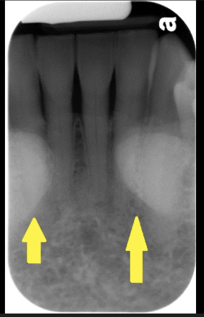 <p>It usually an area in the mandible where there is dense patches of radio opaque bone. Usually near the roots of teeth.</p>