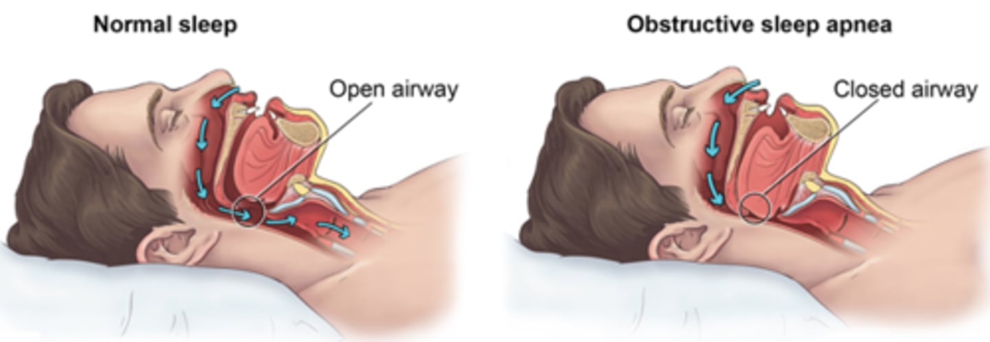 <p>a disorder in which the person stops breathing for brief periods while asleep. This is typically treated with a CPAP machine that helps the airway to stay open while the person is sleeping.</p>