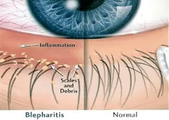 <p>Inflammation of the eyelid margins, specifically meibomain glands. </p>