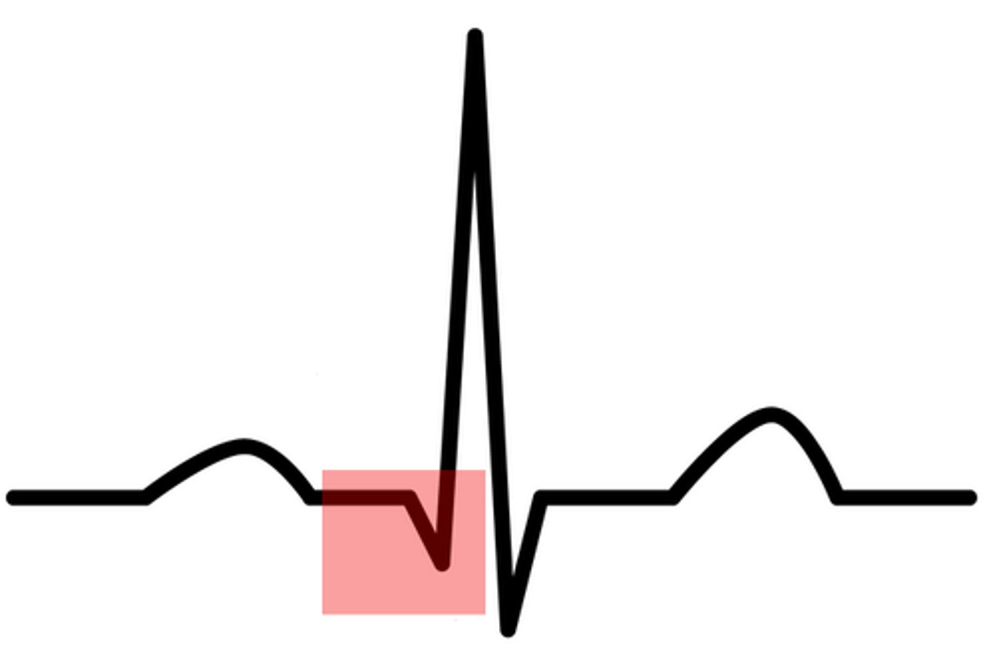 <p>What part of the EKG wave is this?</p>