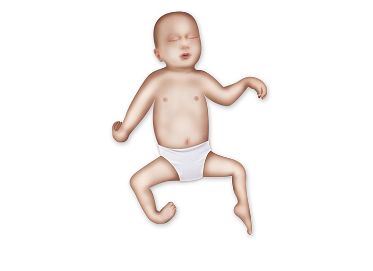 <p><span>-congenital joint contractures </span><br><span>-weakness, limited ROM, Position of rest at the upper extremity is internally rotated, elbows extended, and wrists flexed</span><br><span>-OT for increasing joint ROM, environmental mods,</span></p>