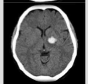 <p>What type of intracranial hemorrhage that occurs due to hypertensive emergency, bleeding mass, or tumors</p>