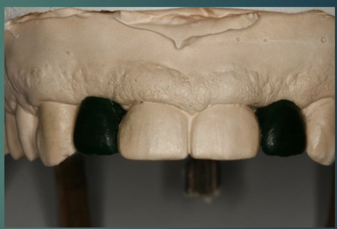 <p>lab will return master cast w full contour wax-up to determine cervical contours occlusion/design </p><ul><li><p>review position and angulation of implant on cast </p></li><li><p>locate screw access channel </p></li><li><p>select abutment- screw retained or cement retained</p></li></ul><p></p>