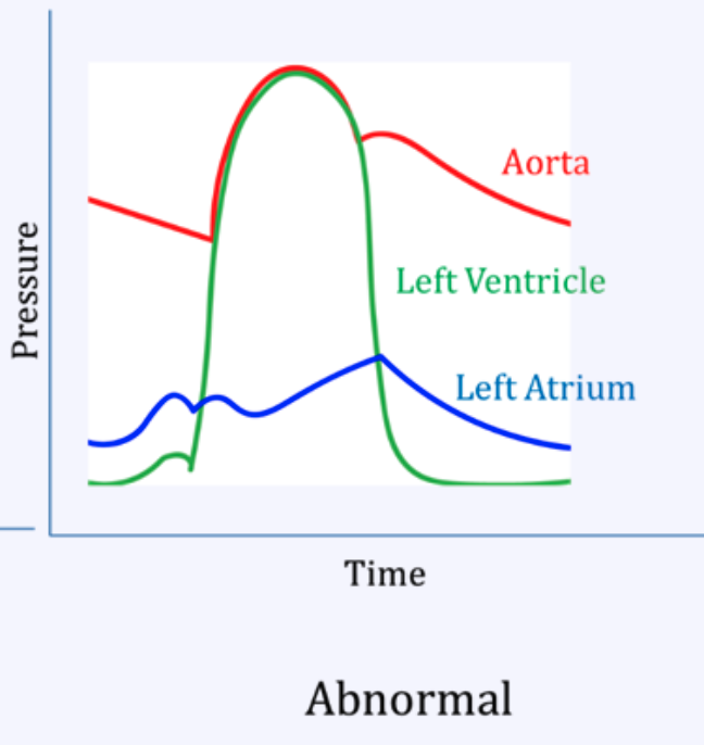 <p>Mitral stenosis</p>