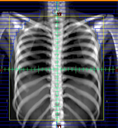 <p>whole lung RT: POP 6 MV</p><p>12-20 Gy to relieve cough and dyspnea</p><ul><li><p>include apex of lung and 1 cm of lateral space</p></li><li><p>we dont treat brachial plexus and humoral head so we shield them</p></li></ul><p></p>