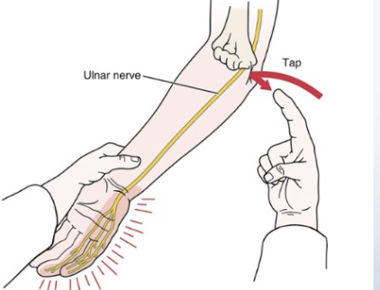 <p><span style="color: #NaNNaNNaN"><strong>•Tests for:</strong></span><span style="color: #NaNNaNNaN"><br></span><span style="color: #NaNNaNNaN">• Ulnar nerve compression/</span><span style="color: #NaNNaNNaN"><br></span><span style="color: #NaNNaNNaN">regeneration status</span><span style="color: #NaNNaNNaN"><br></span><span style="color: #NaNNaNNaN"><strong>•Positive sign: </strong>• Tingling sensation in </span><br><span style="color: #NaNNaNNaN">ulnar distribution (the distribution of these</span><span style="color: #NaNNaNNaN"><br></span><span style="color: #NaNNaNNaN">symptoms informs you how far the nerve has</span><span style="color: #NaNNaNNaN"><br></span><span style="color: #NaNNaNNaN">regenerated/or the level of damage)</span><span style="color: #NaNNaNNaN"><br></span><span style="color: #NaNNaNNaN"><strong>•Method:</strong></span><span style="color: #NaNNaNNaN"><br></span><span style="color: #NaNNaNNaN">• Tap the groove between</span><span style="color: #NaNNaNNaN"><br></span><span style="color: #NaNNaNNaN">the olecranon and medial</span><span style="color: #NaNNaNNaN"><br></span><span style="color: #NaNNaNNaN">epicondyle</span></p>