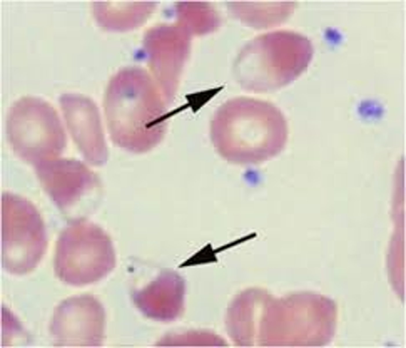 <p>-inherited mutation of the PIEZ01 gene leads to defects in membrane permeability that allows K+ to leak out of the cell, leading to dehydrated RBCs</p><p>-symptoms: mild to moderate anemia, hydrops fetalis, jaundice and splenomegaly</p><p>-reticulocytosis</p><p>-increased MCHC</p><p>-decreased osmotic fragility</p><p>-stomatocytes, target cells, burr cells</p><p>-puddled hemoglobin (shown in picture)</p>