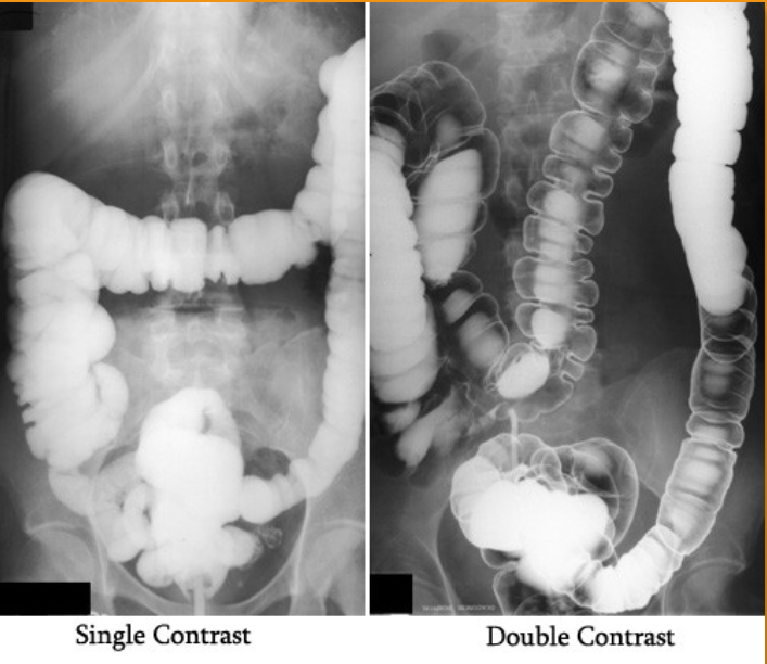 <p>1)What does single contrast mean in the first image?</p><p>2)What does double contrast mean in the 2nd image?</p><p>3)contrast media used for this examination?</p><p>4)the 3 contraindications of the contrast used?</p><p></p>
