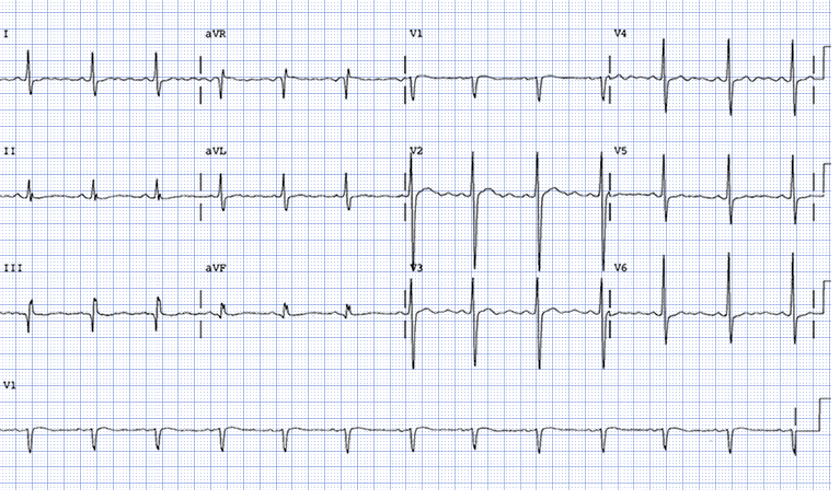 <p>hx anorexia nervosa, passed out on way to bathroom at home</p><p></p><p>U waves after t waves (v2-3 best)</p>