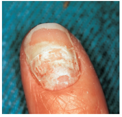 <p>onychomycosis</p>