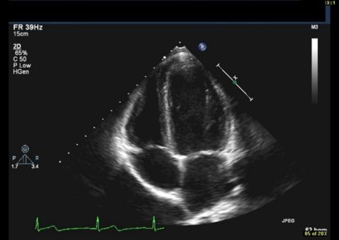 <p>posterior mitral valve leaflet</p>