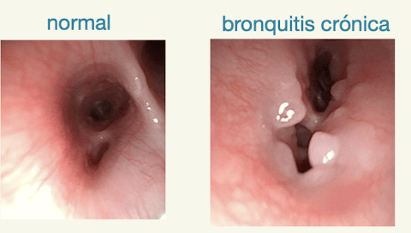 <p>- muchas pruebas para descartar otras enfermedades</p><p>- RX torácica: ↑ opacidad del espacio intersticial/peribronquial, patrón bronquial, hiperinsuflación</p><p>- TAC (menos usado): engrosamiento de las paredes bronquiales</p><p>- broncoscopia (lo más útil): mucosa irregular, sin apariencia brillante, hiperemia, colapso parcial de los bronquios</p><p>- lavado bronquioalveolar: inflam neutrofílica, espirales de curschman (cilindros de moco)</p>