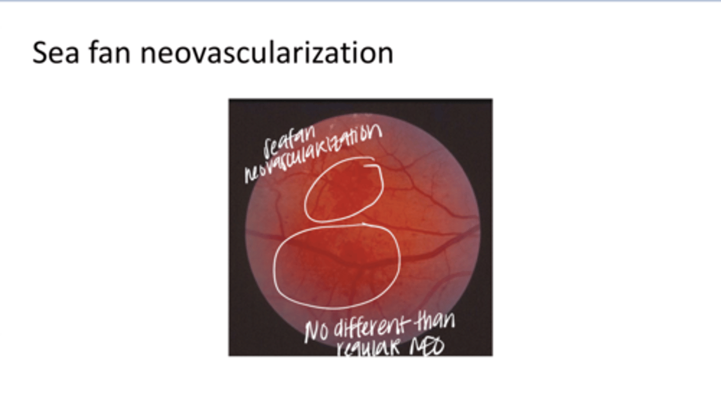 <p>Sea Fan Neovascularization (Pic)</p>