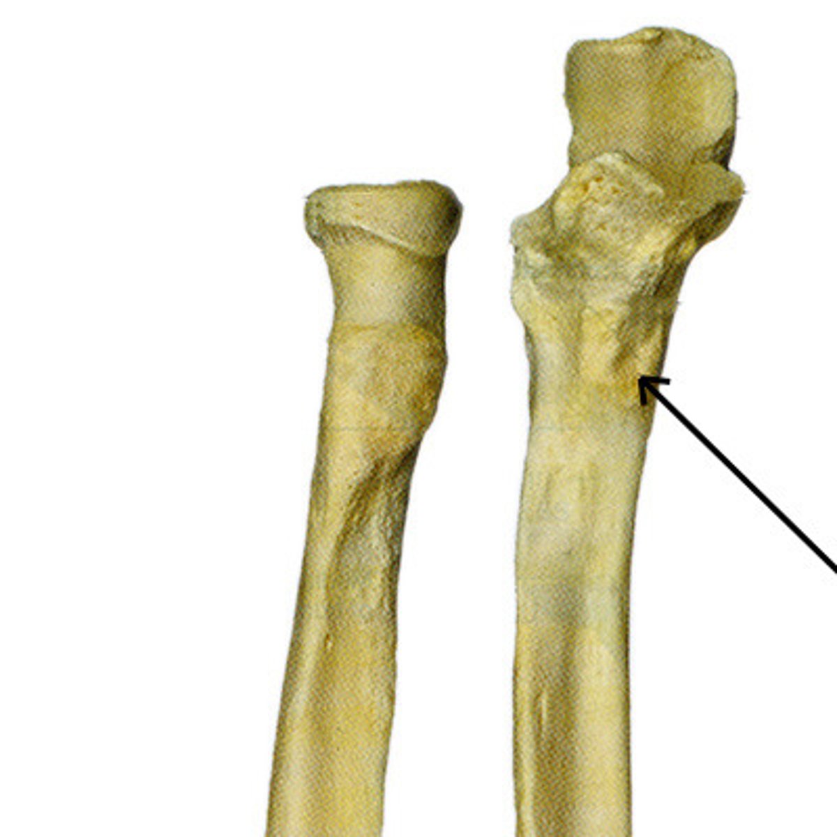 <p>roughened area located on the anterior, proximal ulna inferior to the coronoid process</p>