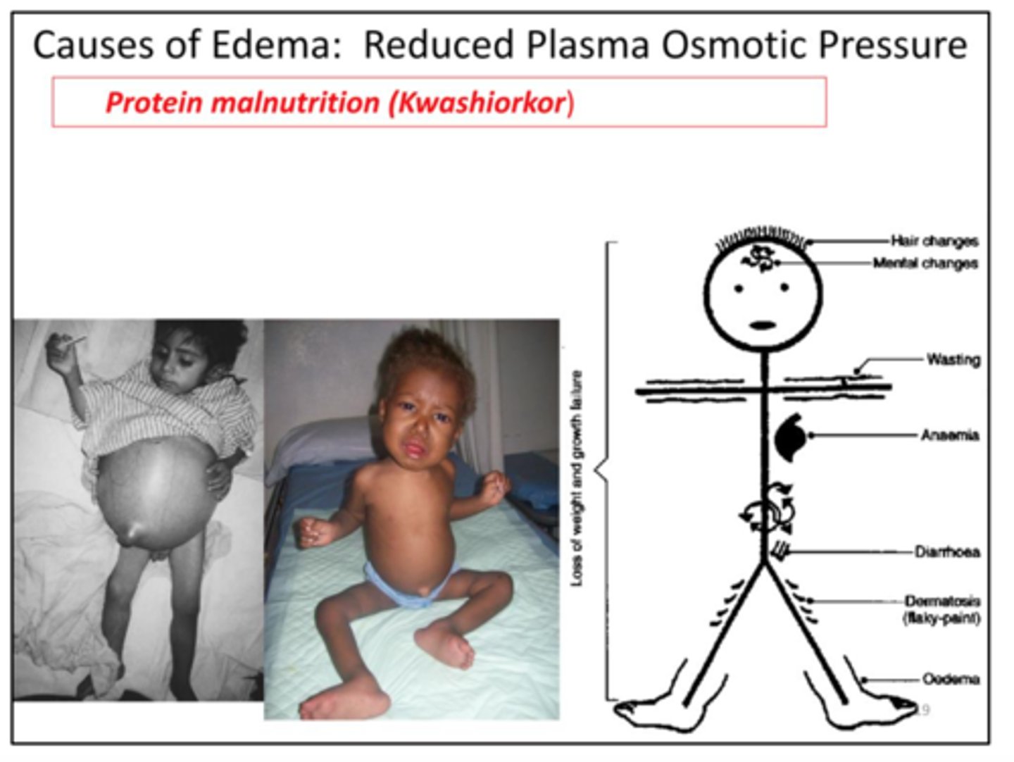 <p>Caused by unbalanced diets lacking protein or essential amino acids-happens when children stop breast-feeding... between 1-3 yrs of age; bloated stomach and physical disabilities.</p>