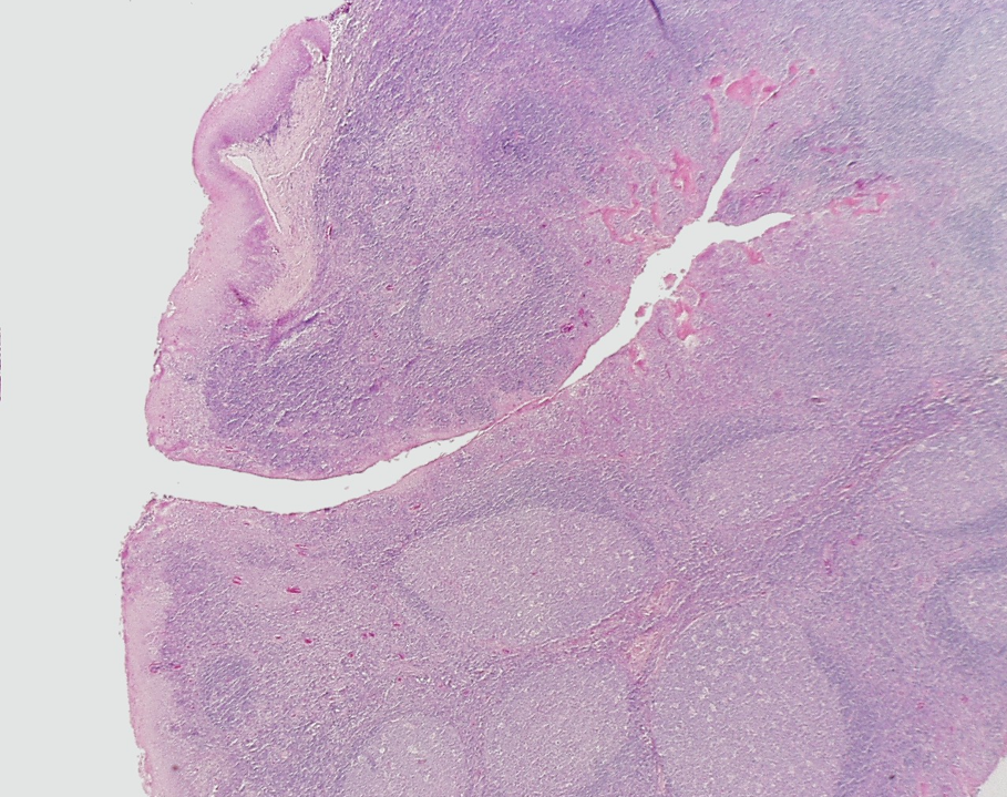 <p><strong>Tonsils </strong></p><p>Crypt and nodules w/ germinal centers observed</p>