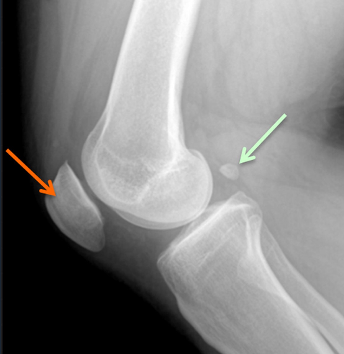 <p>Sesamoid bones</p>