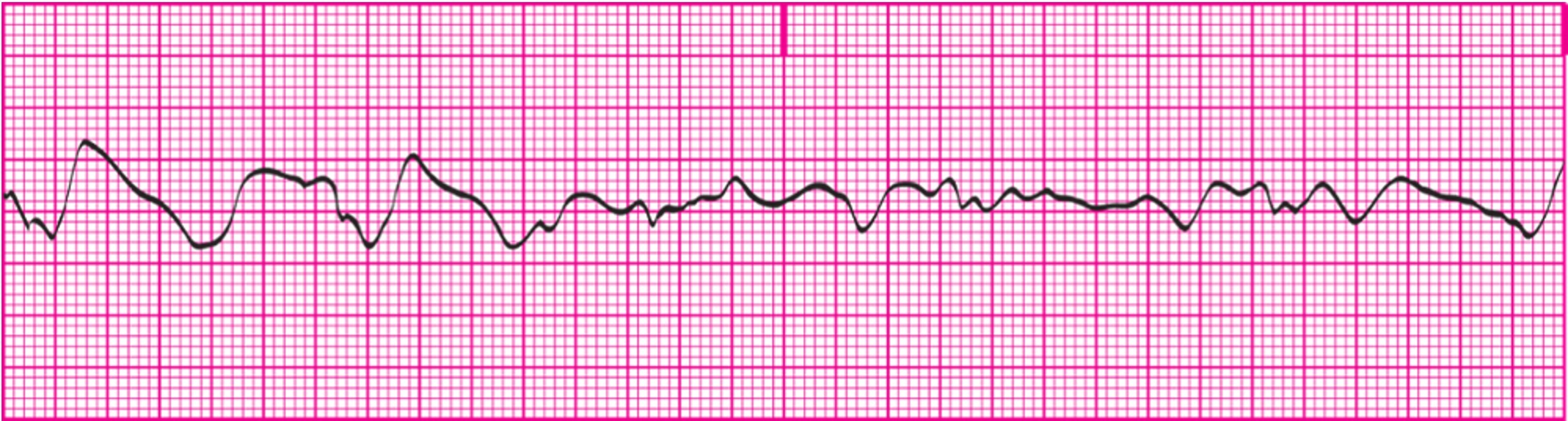 <p>chaotic, asynchronous electrical activity within ventricular tissue; Ventricle walls quiver, preventing ejection of blood; No cardiac output</p><p>Rhythm: P-P and R-R intervals cannot be determined because neither P waves nor R waves are present.</p><p>Rate: Neither the atrial nor the ventricular rate can be determined.</p><p>P wave morphology: No P waves are present.</p><p>PR interval: There is no PR interval.</p><p>QRS duration and morphology: Cannot be determined.</p><p>Always check the patient first.</p><p>In true *<em>Rhythm name</em>* : ***Medical Emergency***</p><p>Patient is unconscious, apneic, and pulseless</p><p>True emergency situation</p><p>Initiate Code Blue and begin CPR/ACLS procedures immediately.</p>