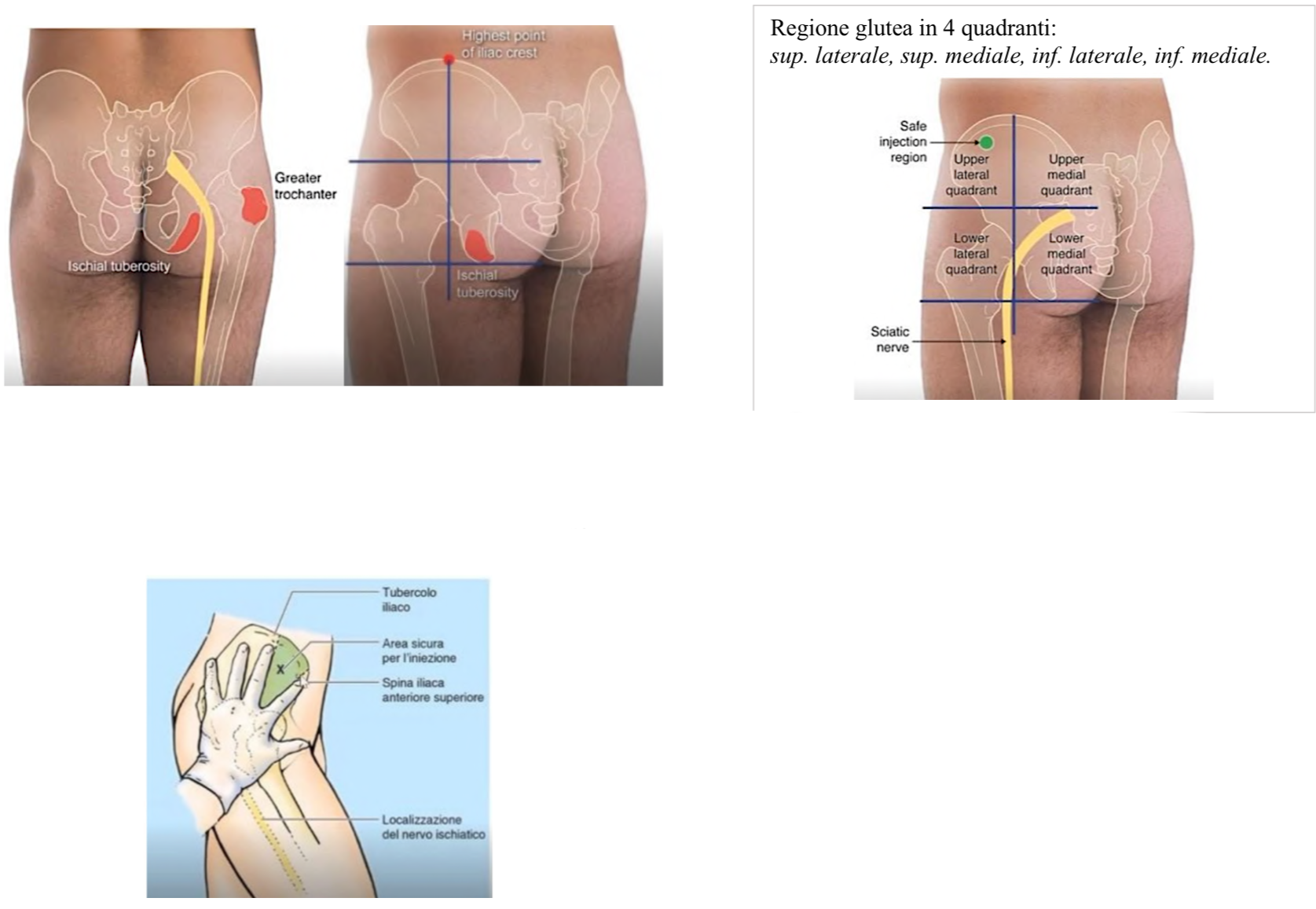 <p>Viene usata la regione glutea → in particolare il quadrante superiore esterno dove raggiungiamo il muscolo medio gluteo </p><p>Questo per evitare di prendere il nervo ischiatico.</p><p>Altra sede è la ventrogluteale, localizzata ponendo:</p><ul><li><p>Indice su spina iliaca anteriore superiore e poi abducendo il medio</p></li><li><p>Il triangolo che si forma è sede di iniezione e qui si coinvolge il tensore della fascia lata</p></li><li><p>Questa è la sede di elezione, più libera da vasi e nervi</p></li></ul><p></p>