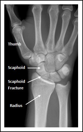 <p>left scaphoid fracture</p><ul><li><p>pain in the anatomical snuffbox → median nerve damage</p></li><li><p><span>numbness in the radial three digits of the hand</span></p></li></ul><p></p>