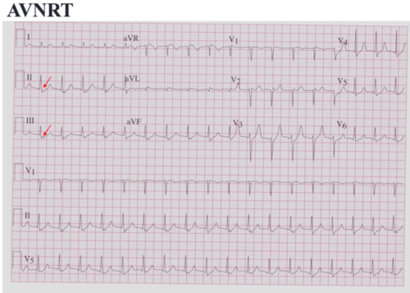 <p>atrioventricular nodal reentrant tachycardia</p><p>Caused by Slow / fast pathways, different refractory periods, making a loop.</p>
