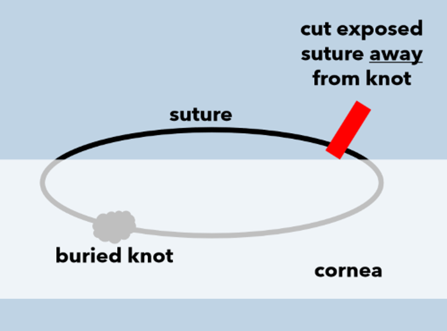 <p>Explain the process for removing sutures after a PKP.</p>