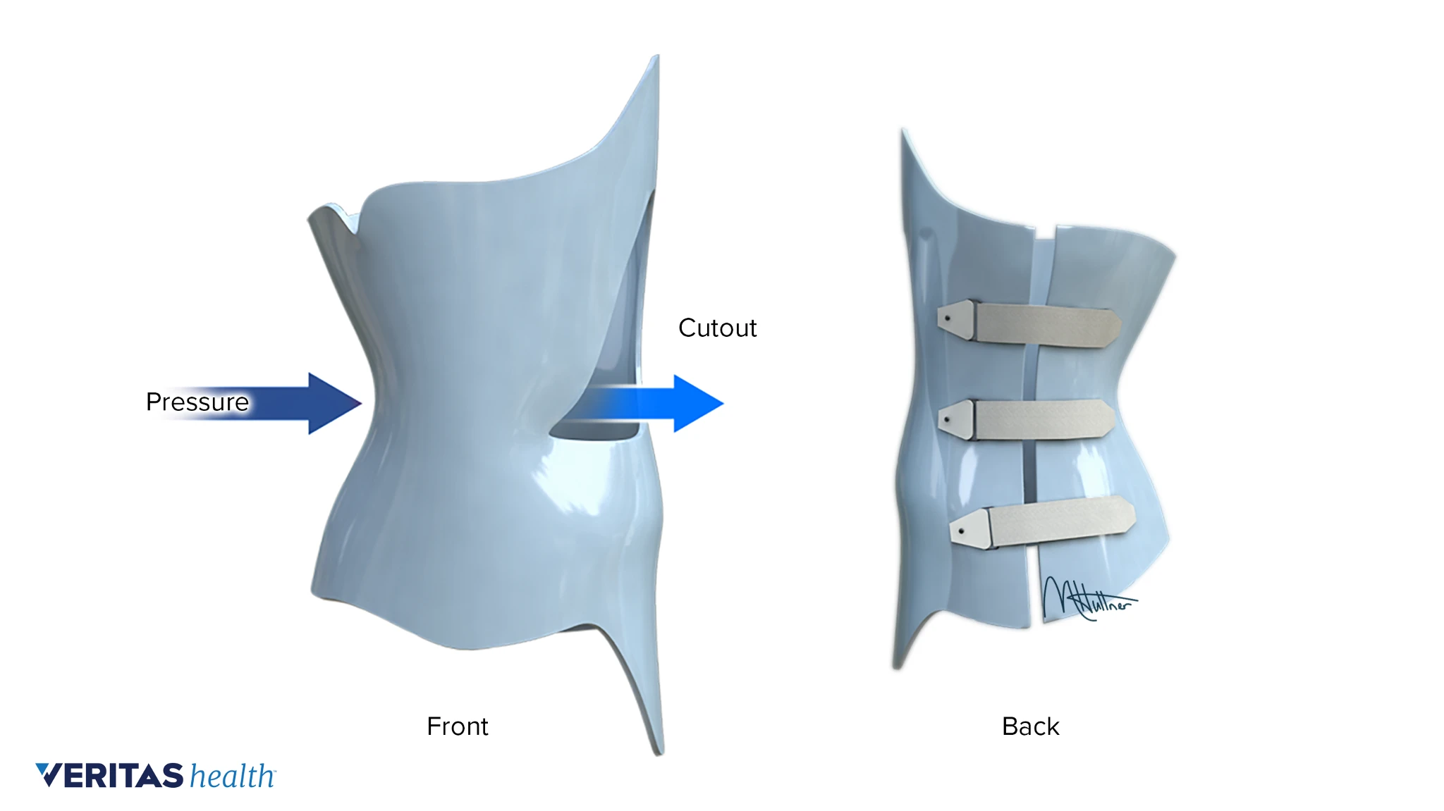 <p>- prevent curve progression</p><p>- stabilize the spine</p><p>- for curves below T8 and 25-35 degrees with apex of T7</p>