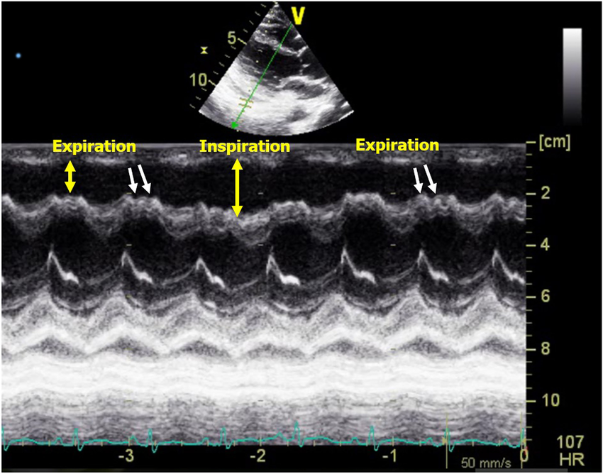 <p>What condition is seen in the following m-mode image?</p>
