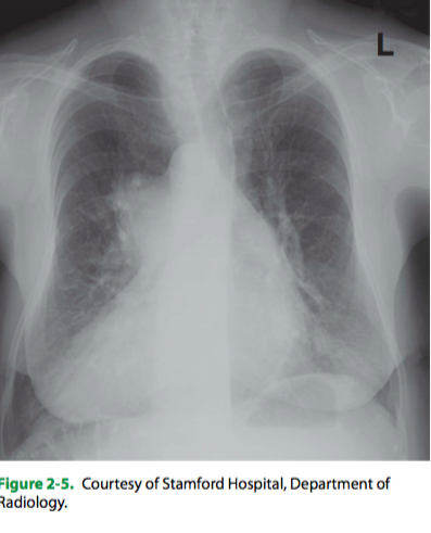 (D) Dextrocardia