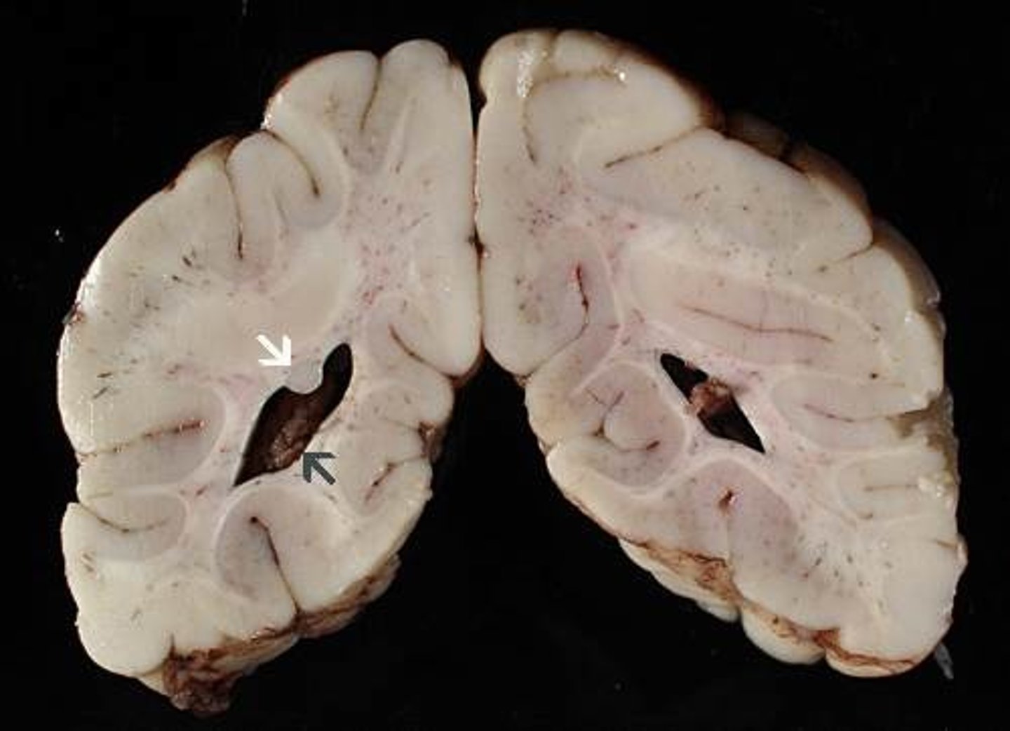 <p>Define Neuronal heterotopias</p>