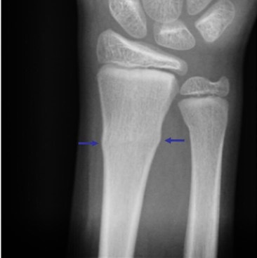 <p>Torus or Buckle (fracture)</p>