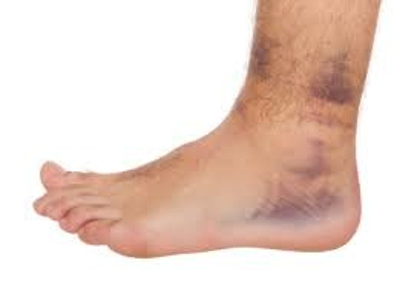 <p>Anterior talofibular ligament (ATFL)</p>