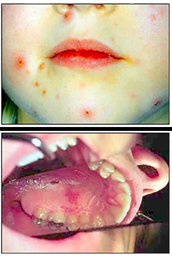 <p><span style="color: blue;"><strong><em><u>SPECIFIC INFECTIONS</u></em></strong></span></p><p>Varicella zoster: Chickenpox (top)/ Shingles (bottom)</p><ul><li><p>Clinical Signs</p></li><li><p>Etiology</p></li><li><p>Treatment</p></li></ul><p></p>