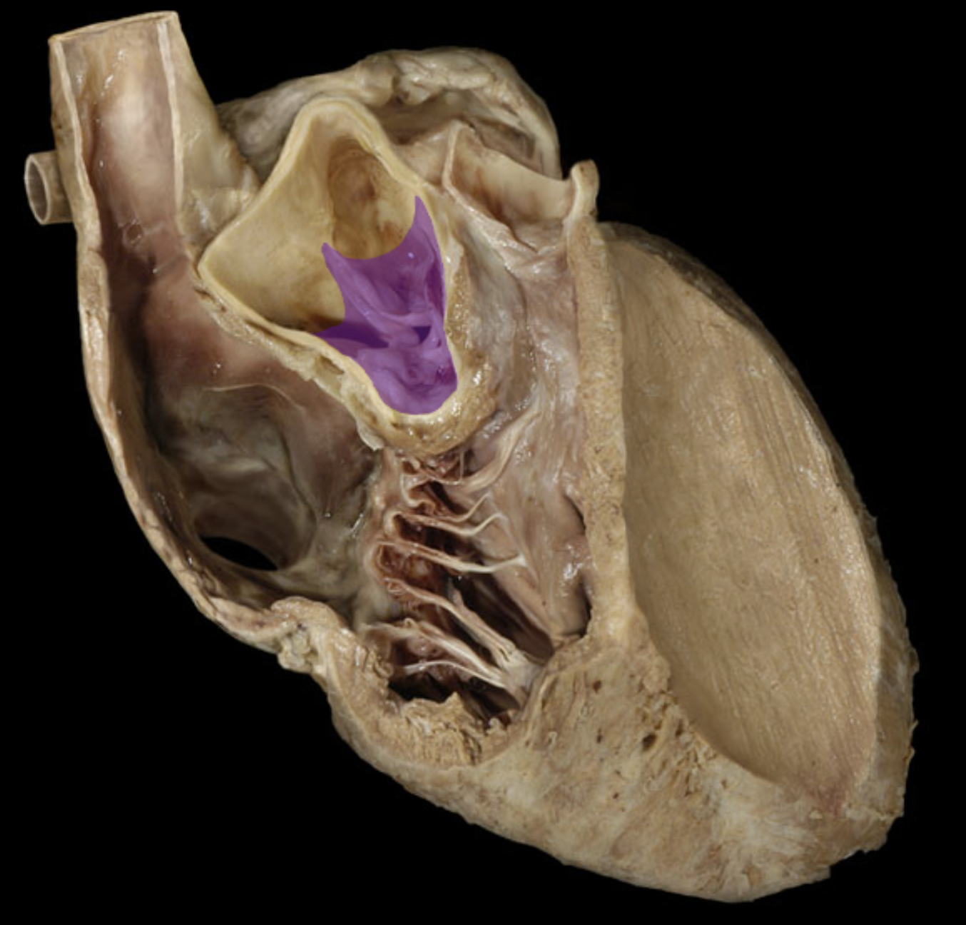 <p>Aortic Valve </p>