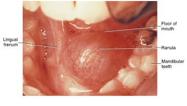<ul><li><p>retention of saliva in the gland can result in this if it involved the sublingual salivary gland</p></li><li><p>lesion is managed by removal of the stone or surgical removal of gland</p></li></ul><p></p>