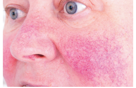 <p>rosacea</p>