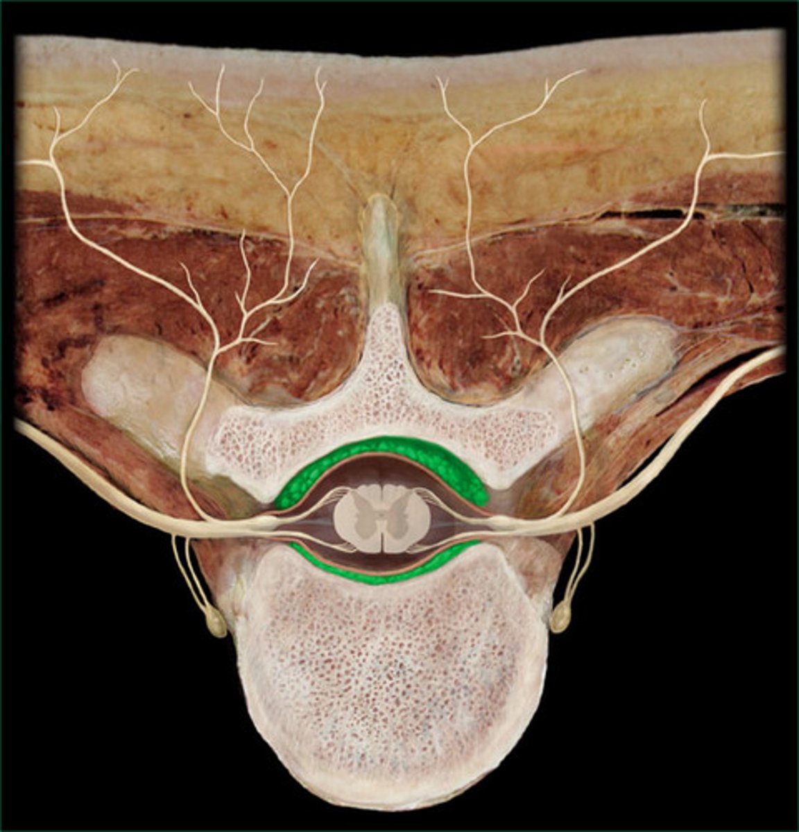 <p>space between the dura mater and the wall of the vertebral canal</p>