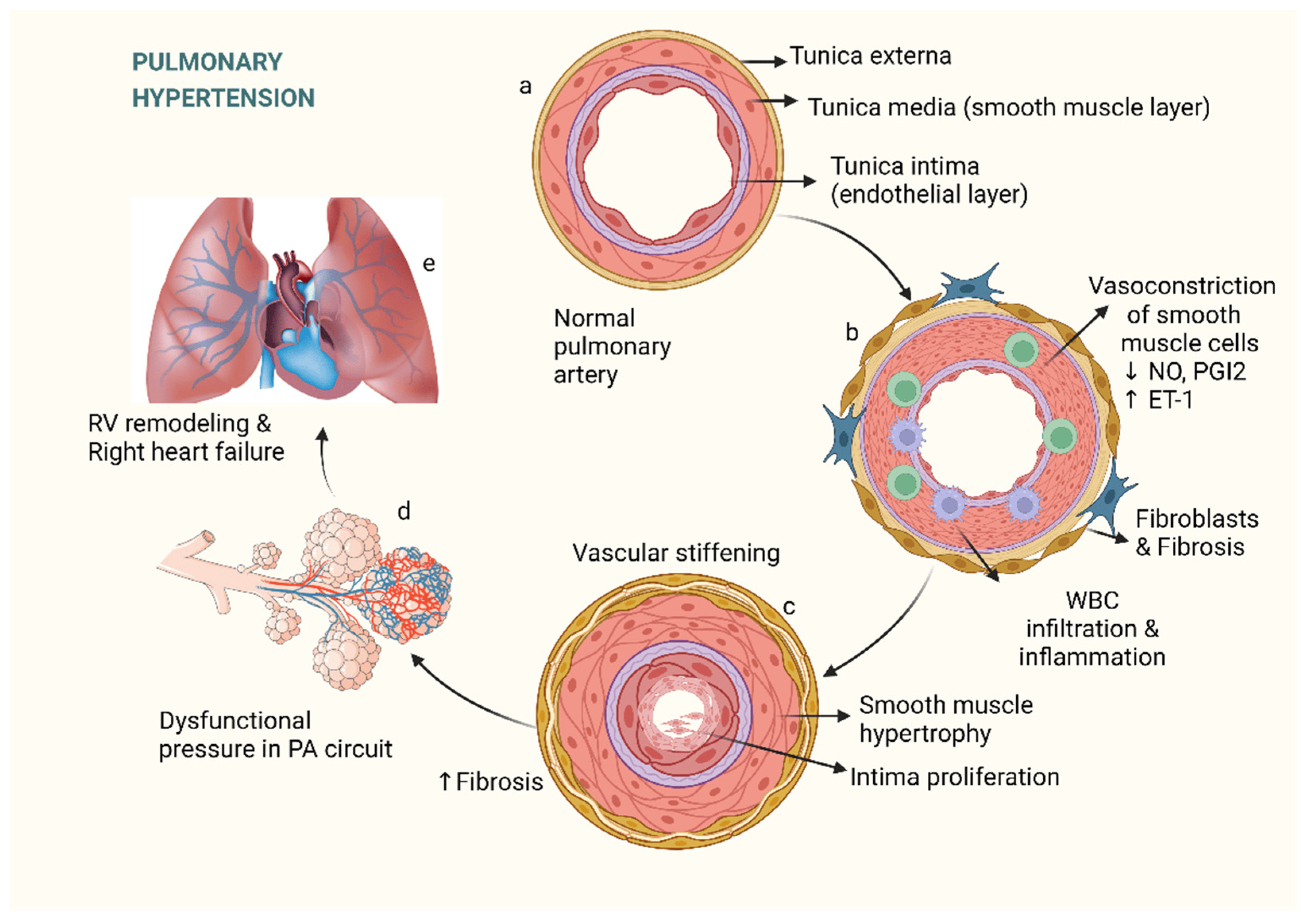 <p>Lungartärerna kommer vid KOL att bli mindre samtidigt som det sker <strong>vaskulär remodellering</strong> → mer fibros och hypertrofi av tunica media. Det leder till en vaskulär stelhet och högre tryckbelastning för höger kammare → cor pulmonale (högersvikt). </p><p>Det sker <strong>generell vasokonstriktion </strong>eftersom det är hypoxi och perfusionen försöker matcha ventilationen. </p>