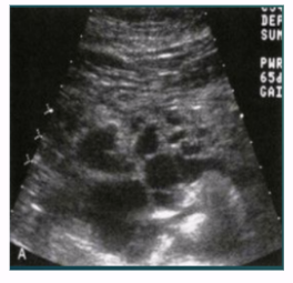 <ul><li><p><span style="background-color: transparent;">Genetic disorder that involves central nervous system</span></p></li><li><p><span style="background-color: transparent;">Includes adenomas and islet cell tumors</span></p></li><li><p><span style="background-color: transparent;">65-75% of pts have some form of pancreatic lesion</span></p></li><li><p><span style="background-color: transparent;">Peripheral calcifications possible</span></p></li></ul><p></p>