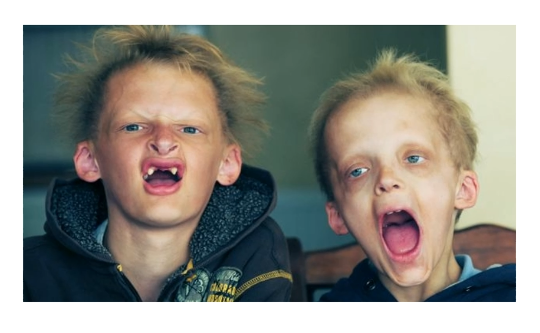 <p>What condition is this?</p><p>They look like vampires</p>
