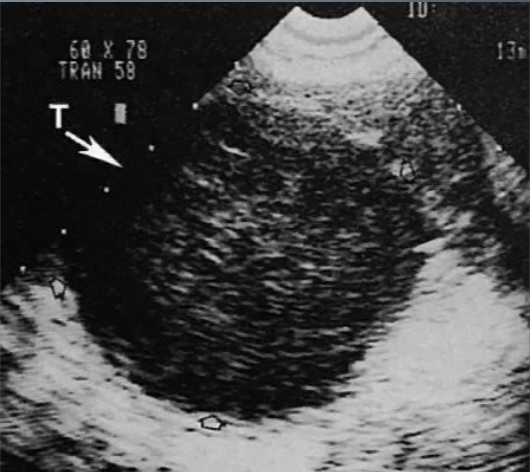 <ul><li><p><span style="color: #ff7000">Estrogen-producing</span></p></li><li><p>Solid</p></li><li><p>1-2% of ovarian tumors</p></li><li><p><strong>Abnormal uterine bleeding</strong> due to estrogen</p></li><li><p>Usually unilateral</p></li><li><p>May measure <span style="color: #ff0000">up to 30 cm</span></p></li><li><p><u>Most frequently</u> occur in <span style="color: #a700ff">post-menopausal women</span></p></li><li><p>Shadowing is common</p></li></ul><p></p>